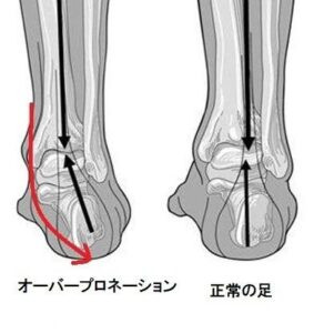 オーバープロネーション